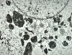 F,17y. | megamitochondria - Wilson disease